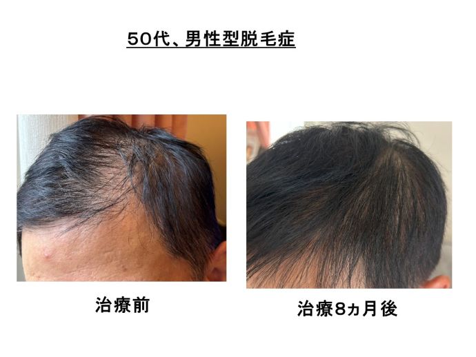 円形脱毛症　病院